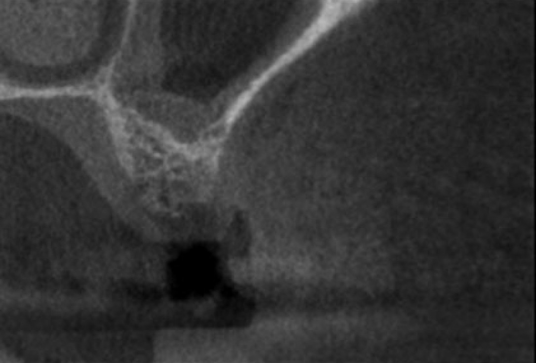 Socket preservation with permamem® - Dr. R. Rannula