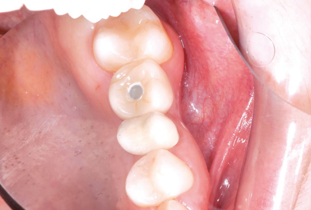 Socket preservation with permamem® - Dr. R. Rannula