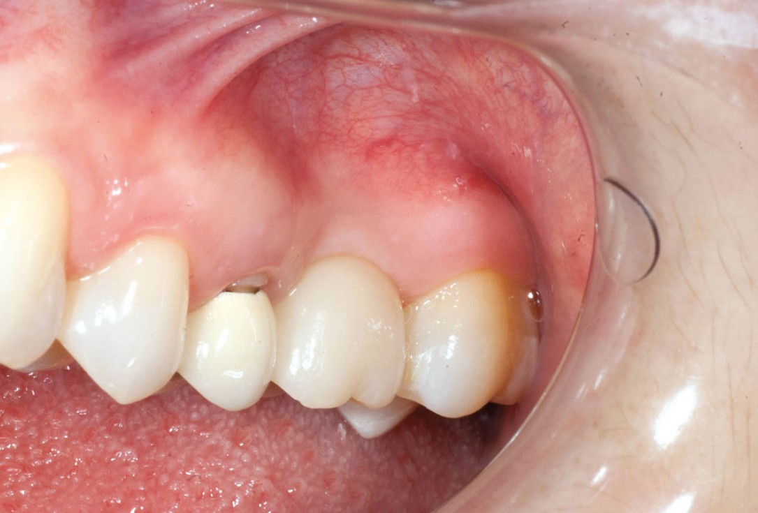 Socket preservation with permamem® - Dr. R. Rannula