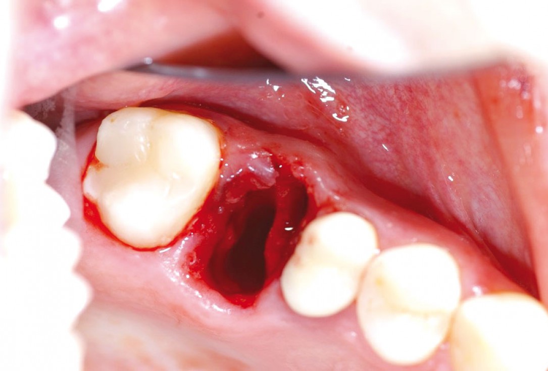 Socket preservation with permamem® - Dr. R. Rannula