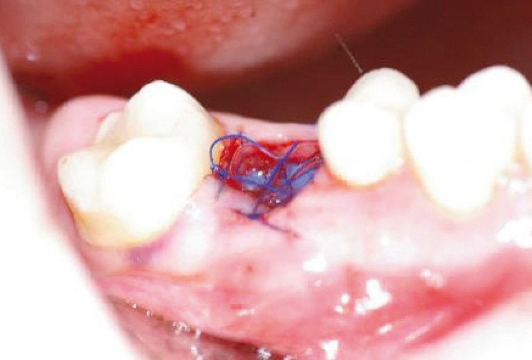 Socket preservation with permamem® - Dr. R. Rannula