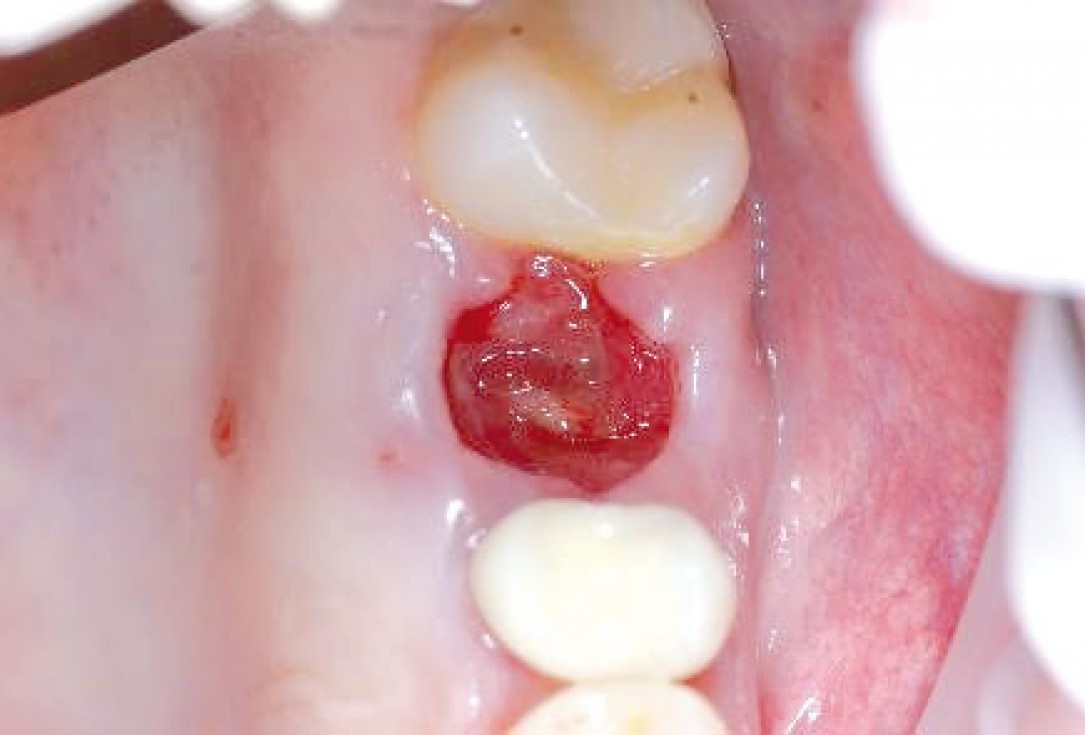 Socket preservation with permamem® - Dr. R. Rannula