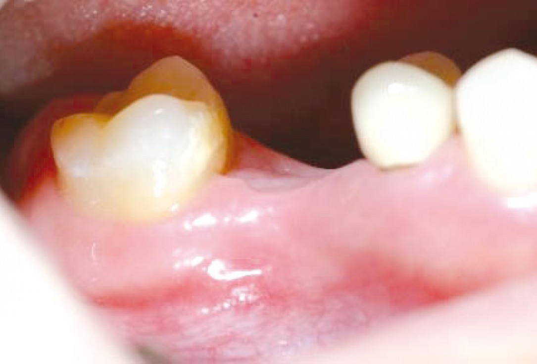 Socket preservation with permamem® - Dr. R. Rannula