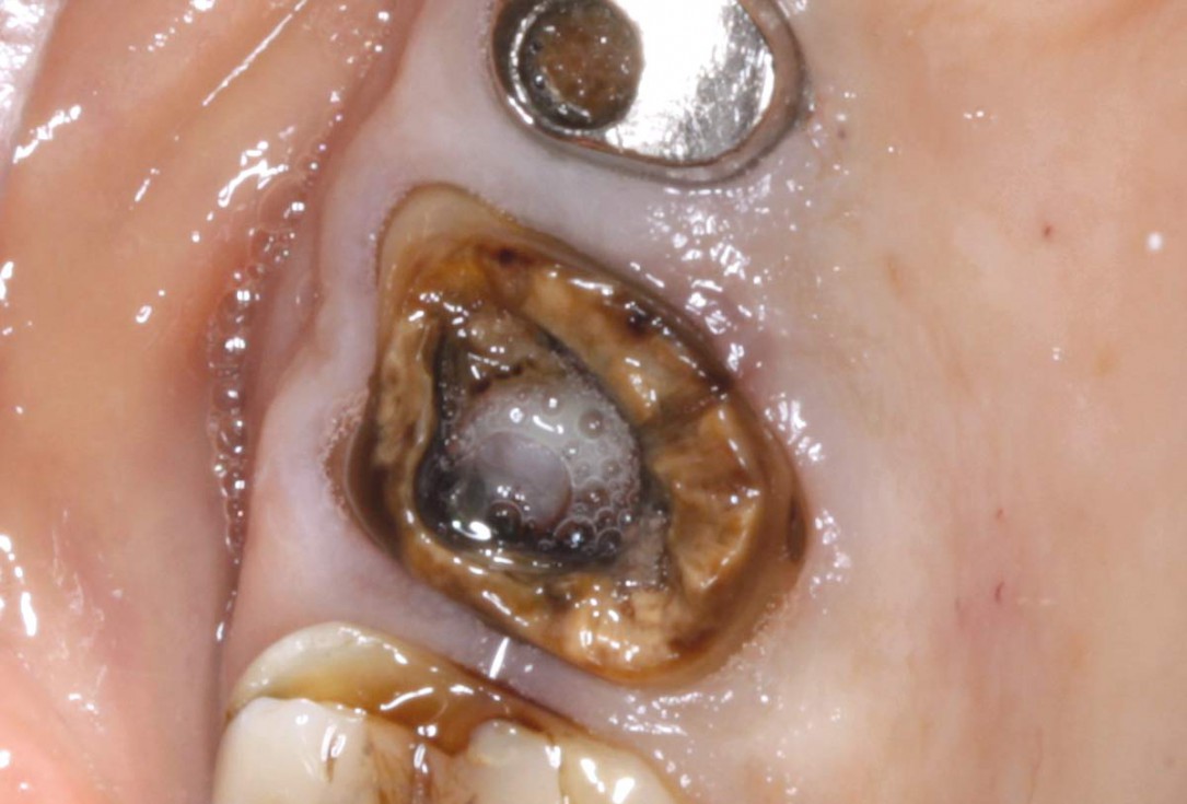 01/07 Socket preservation with permamem® - Dr. M. Turco