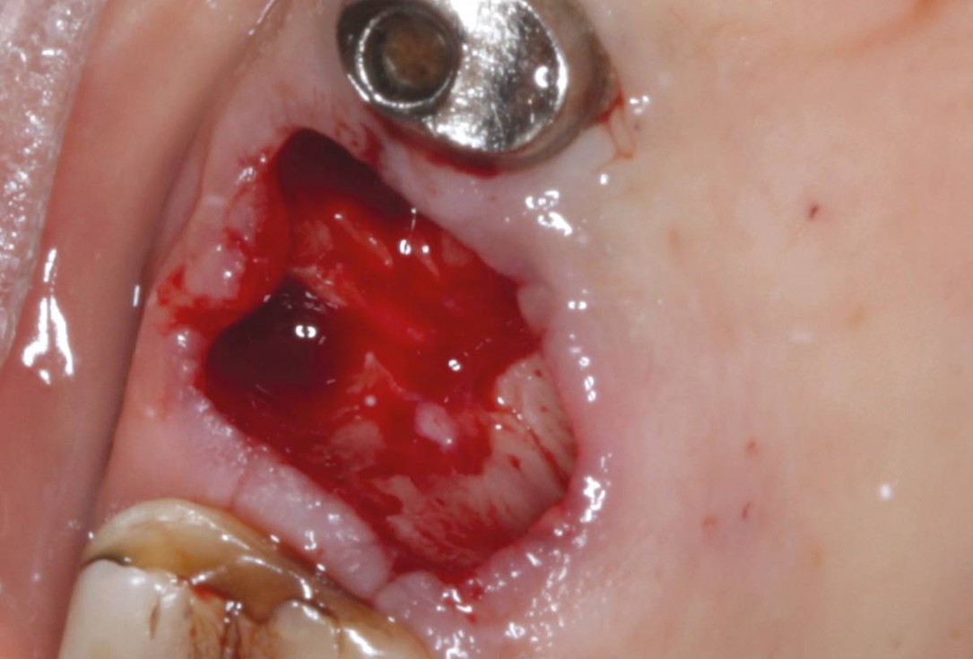 02/07 Socket preservation with permamem® - Dr. M. Turco