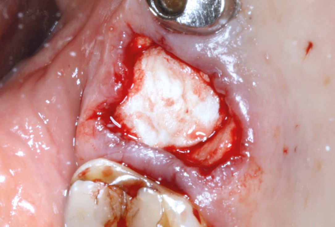 03/07 Socket preservation with permamem® - Dr. M. Turco