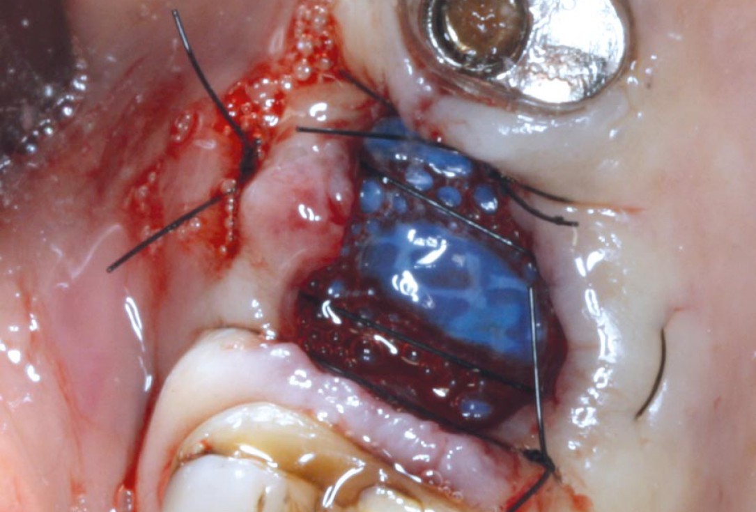 05/07 Socket preservation with permamem® - Dr. M. Turco