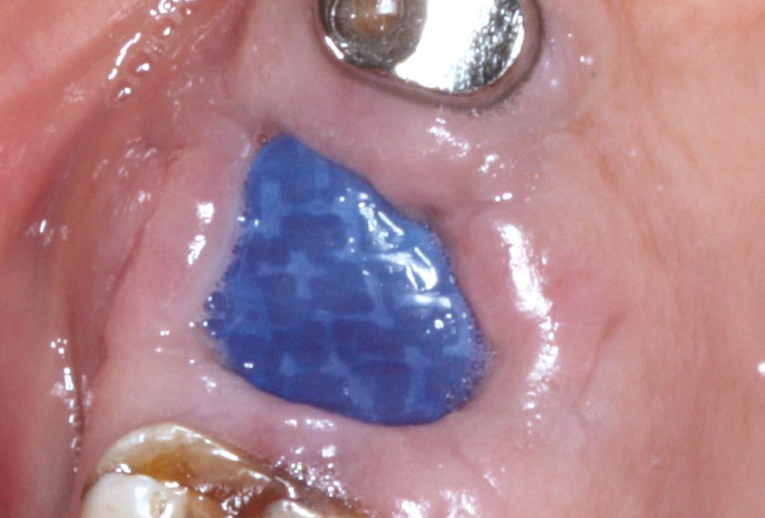 06/07 Socket preservation with permamem® - Dr. M. Turco