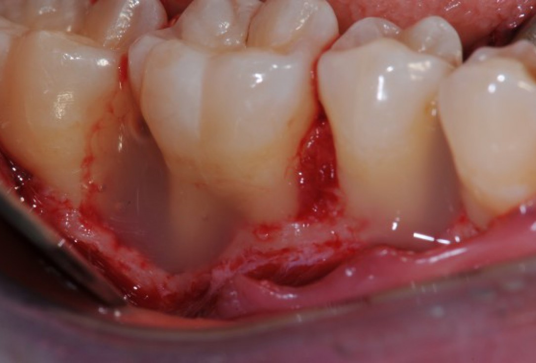 Deep intrabony defects treated using Straumann® Emdogain® - Dr. M. Stefanini