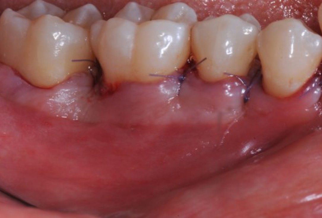 Deep intrabony defects treated using Straumann® Emdogain® - Dr. M. Stefanini