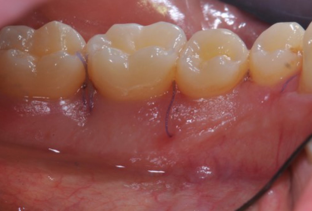 Deep intrabony defects treated using Straumann® Emdogain® - Dr. M. Stefanini