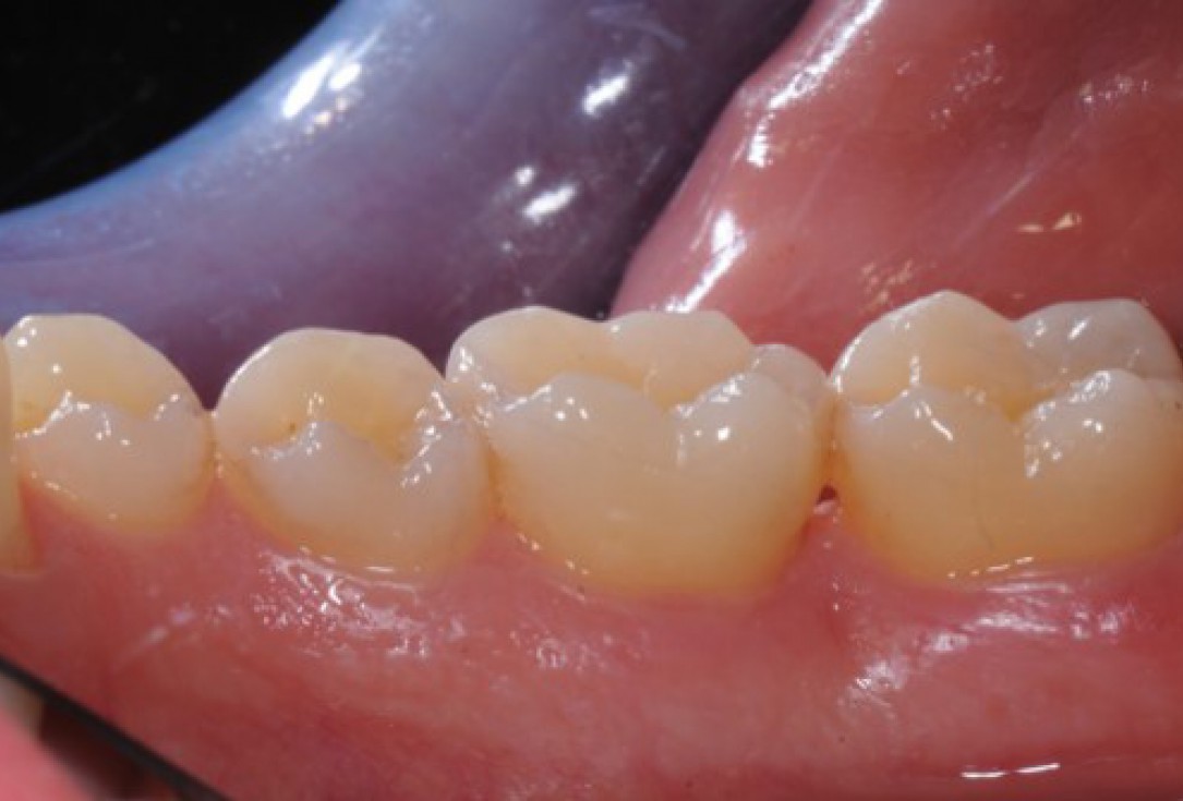 Deep intrabony defects treated using Straumann® Emdogain® - Dr. M. Stefanini