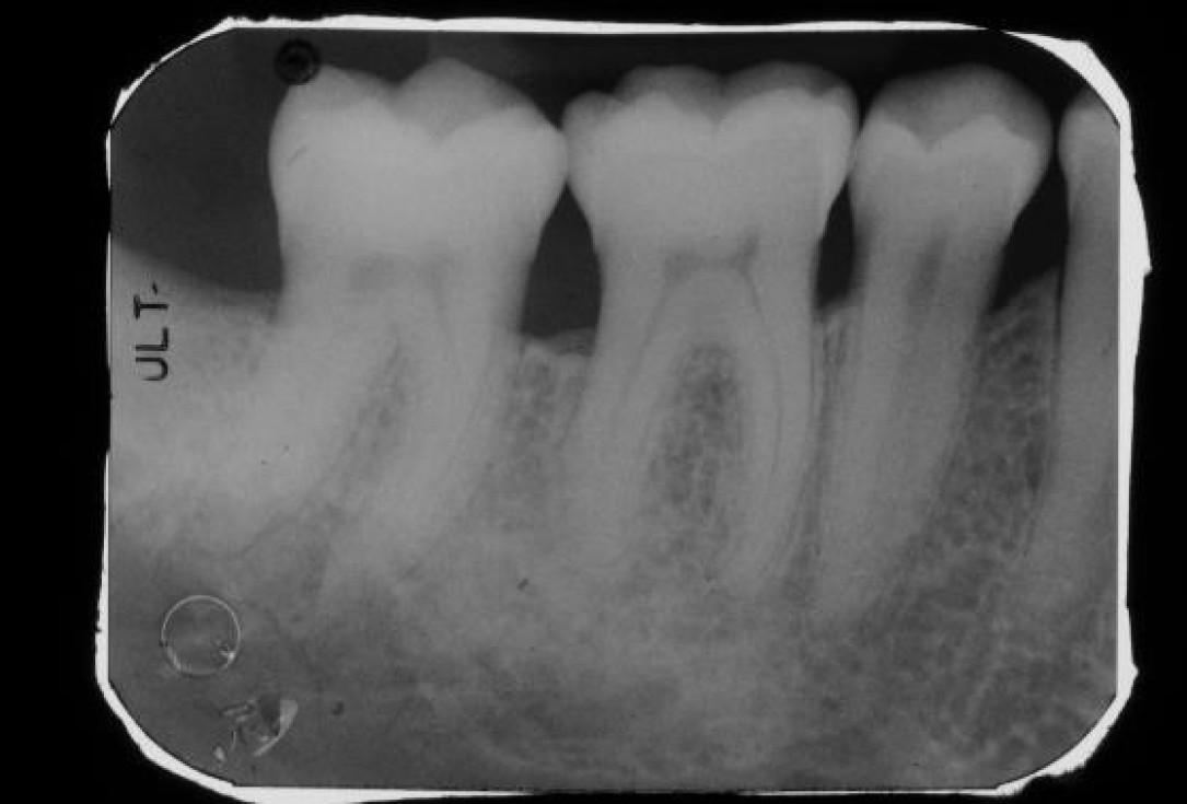 Deep intrabony defects treated using Straumann® Emdogain® - Dr. M. Stefanini