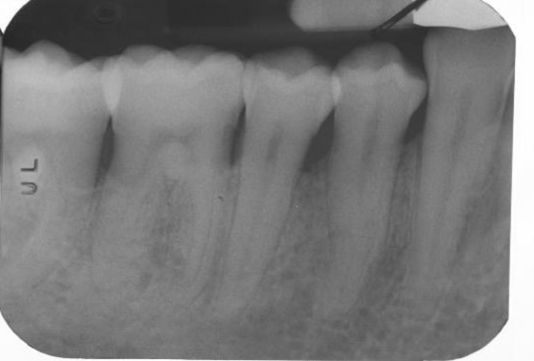 Deep intrabony defects treated using Straumann® Emdogain® - Dr. M. Stefanini