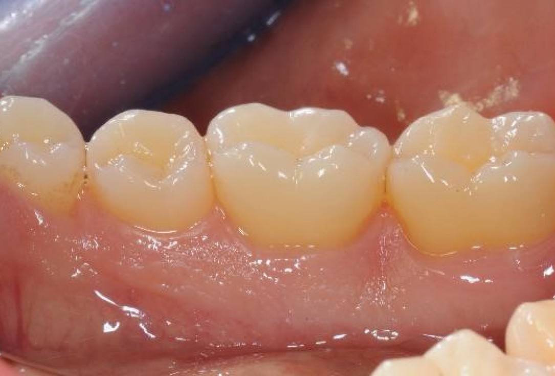 Deep intrabony defects treated using Straumann® Emdogain® - Dr. M. Stefanini