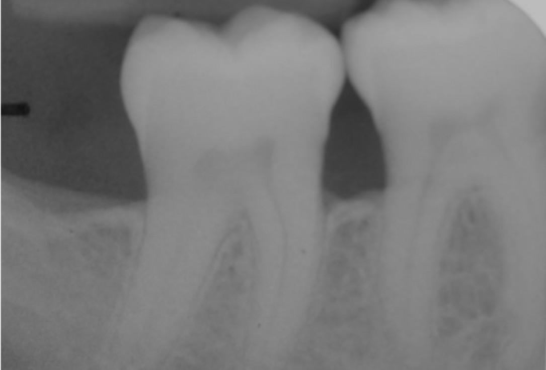 Deep intrabony defects treated using Straumann® Emdogain® - Dr. M. Stefanini