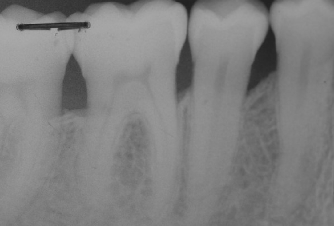 Deep intrabony defects treated using Straumann® Emdogain® - Dr. M. Stefanini