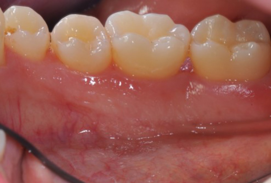 Deep intrabony defects treated using Straumann® Emdogain® - Dr. M. Stefanini