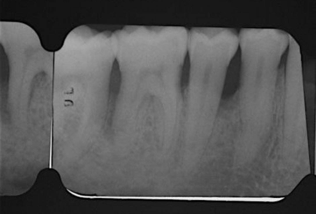 Deep intrabony defects treated using Straumann® Emdogain® - Dr. M. Stefanini