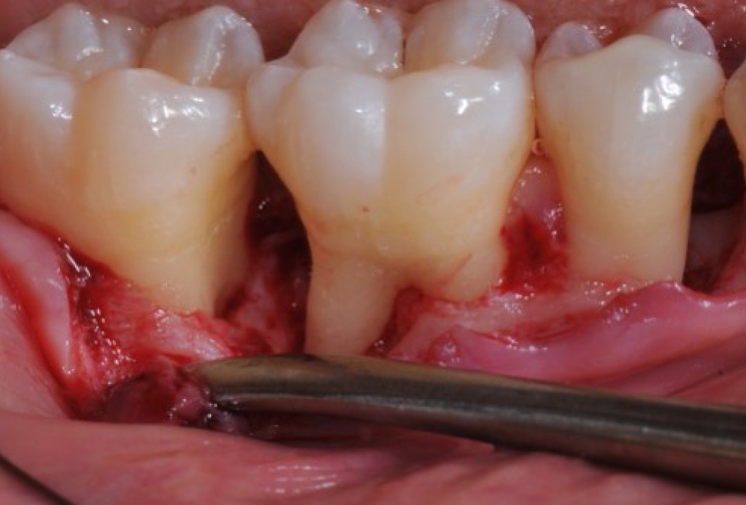 Deep intrabony defects treated using Straumann® Emdogain® - Dr. M. Stefanini