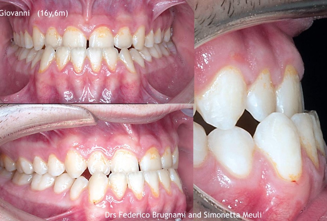 Regenerative corticotomy to compensate lower incisor malocclusion with cerabone® and mucoderm®