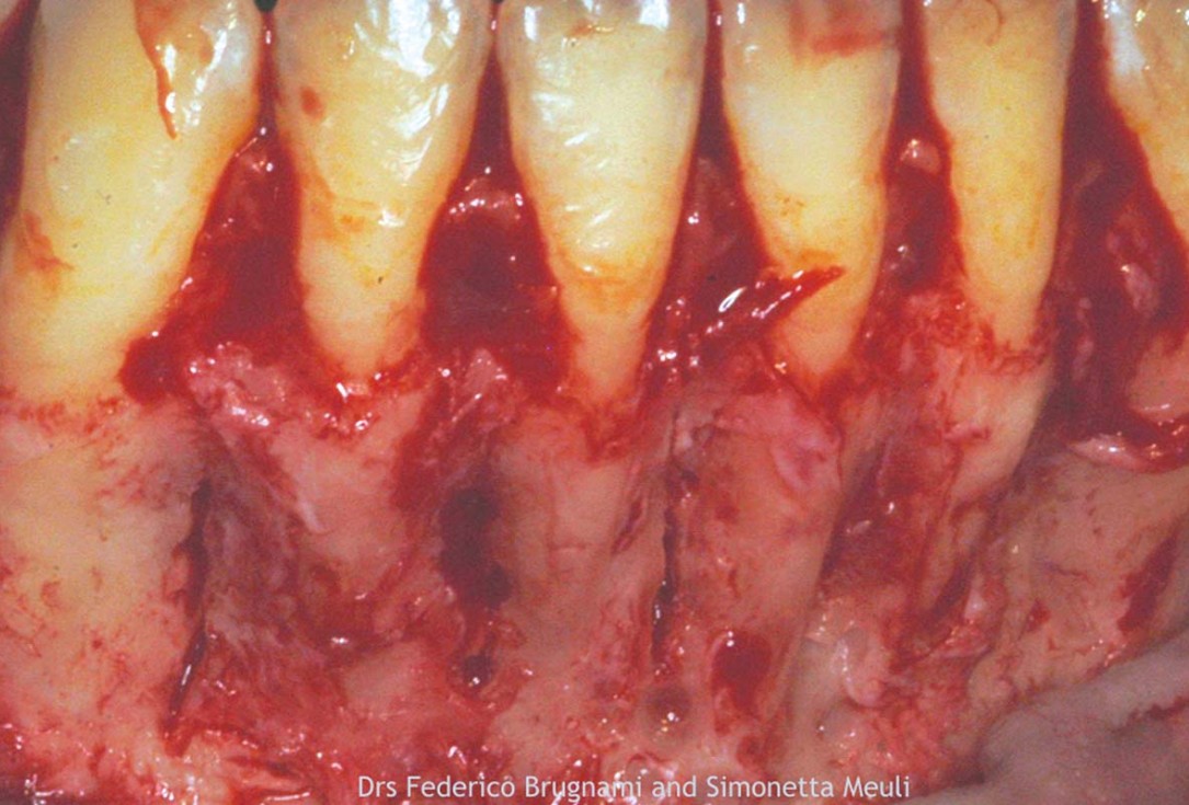 Regenerative corticotomy to compensate lower incisor malocclusion with cerabone® and mucoderm®