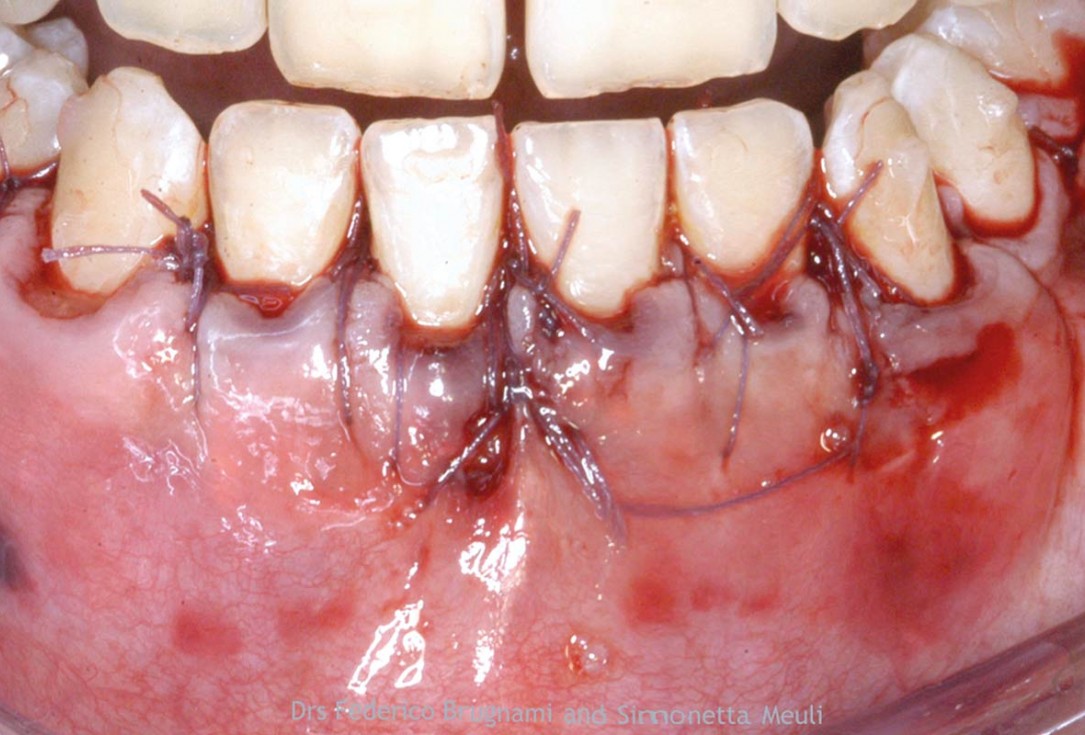 Regenerative corticotomy to compensate lower incisor malocclusion with cerabone® and mucoderm®