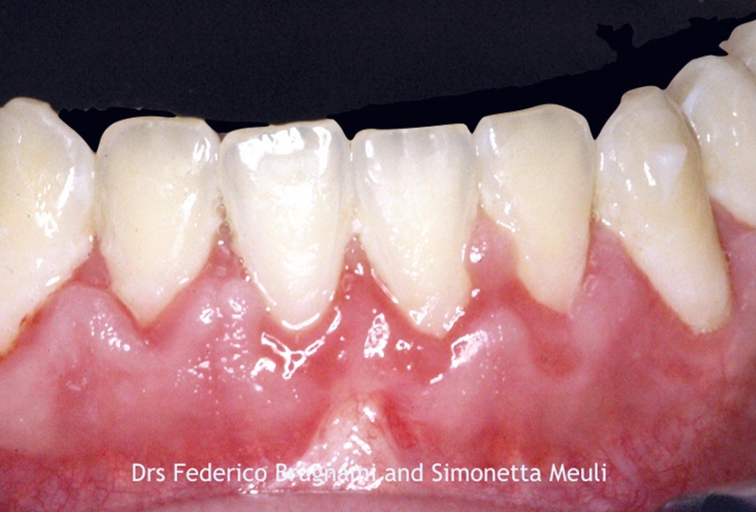 Regenerative corticotomy to compensate lower incisor malocclusion with cerabone® and mucoderm®