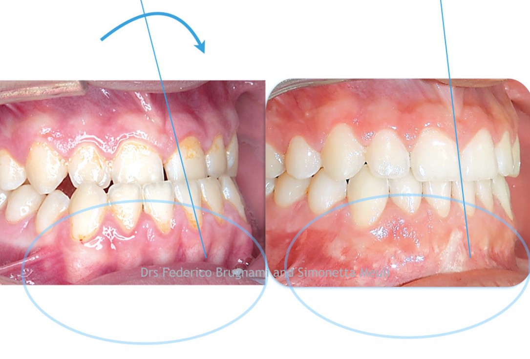 Regenerative corticotomy to compensate lower incisor malocclusion with cerabone® and mucoderm®