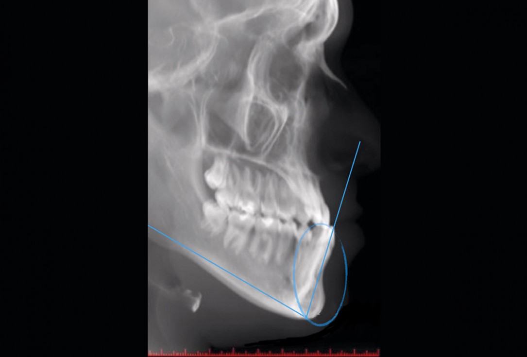 Regenerative corticotomy to compensate lower incisor malocclusion with cerabone® and mucoderm®