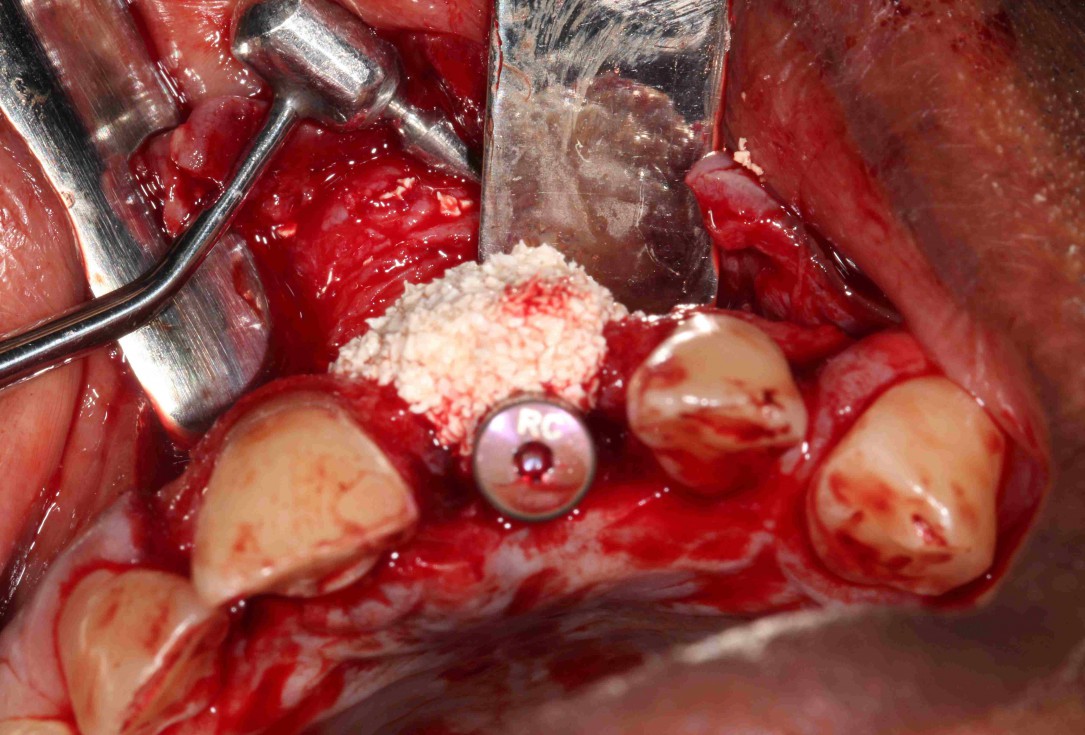 GBR with cerabone® and Jason® membrane in the front tooth region - Dr. H. Maghaireh 