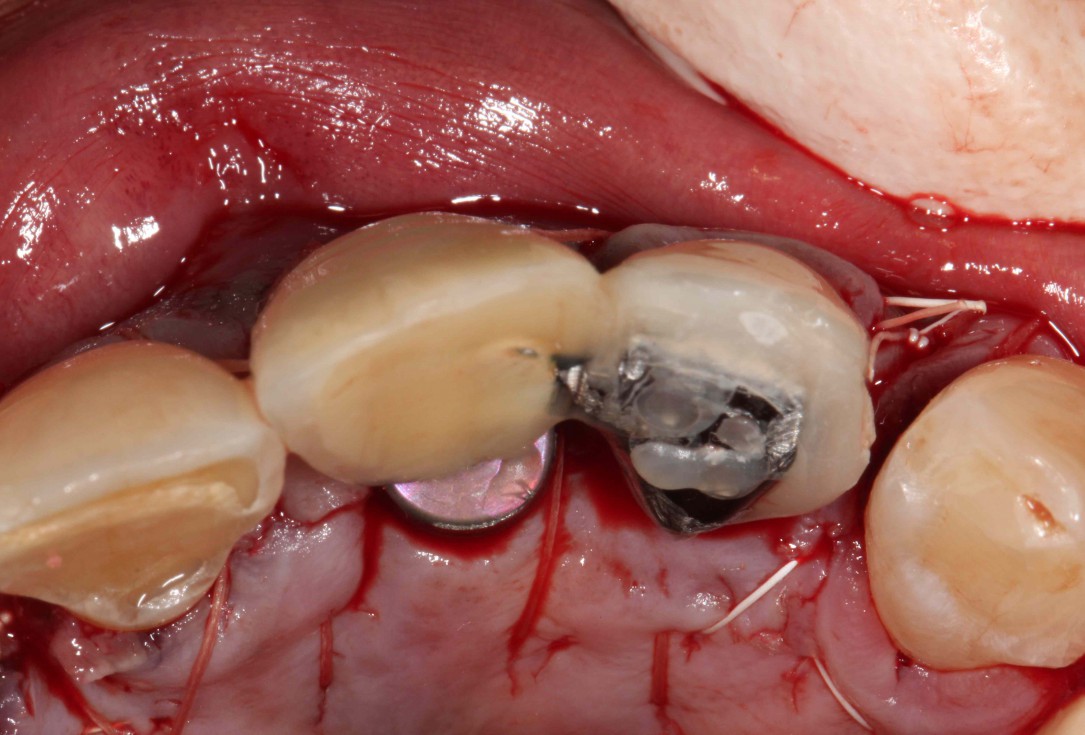 GBR with cerabone® and Jason® membrane in the front tooth region - Dr. H. Maghaireh 