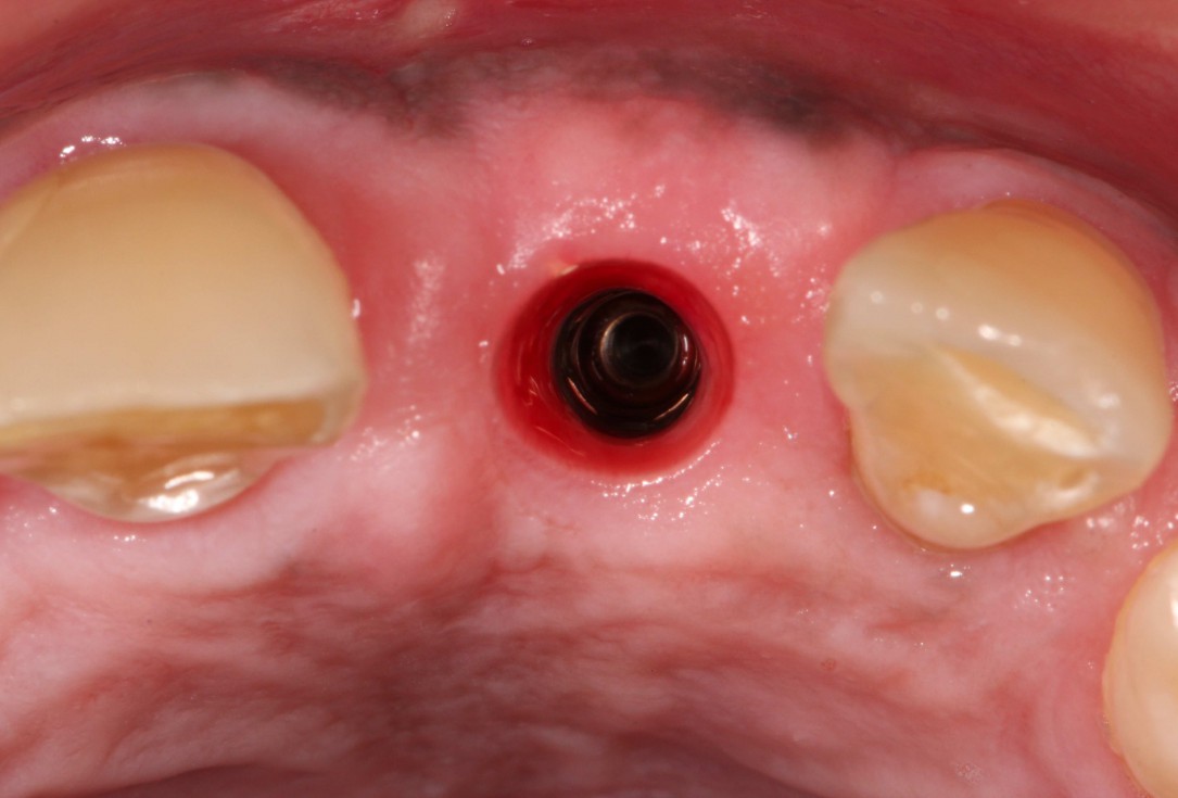 GBR with cerabone® and Jason® membrane in the front tooth region - Dr. H. Maghaireh 