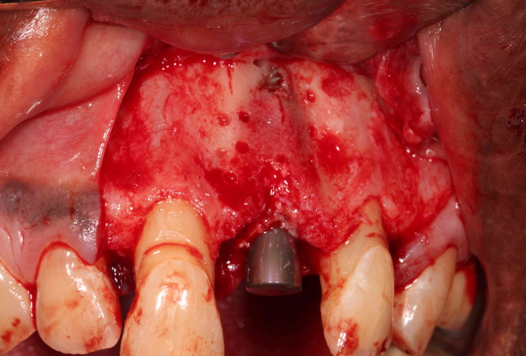 GBR with cerabone® and Jason® membrane in the front tooth region - Dr. H. Maghaireh 
