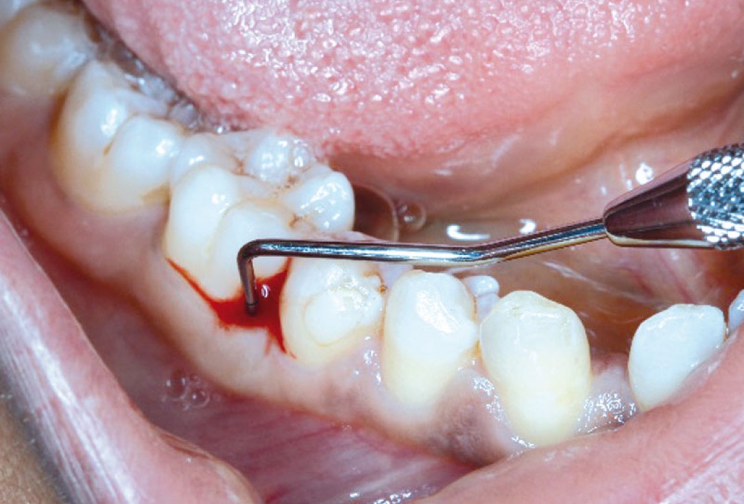 Regeneration at LR6 with cerabone® and collprotect® membrane using simple papilla preservation technique-1