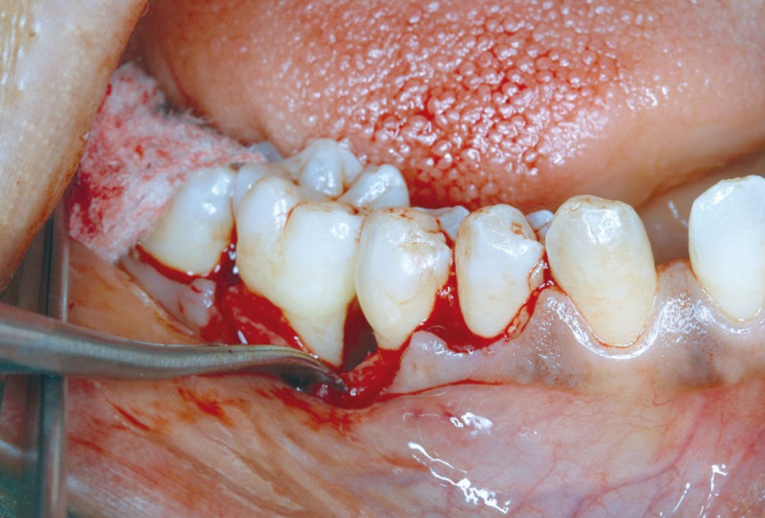 Regeneration at LR6 with cerabone® and collprotect® membrane using simple papilla preservation technique-2