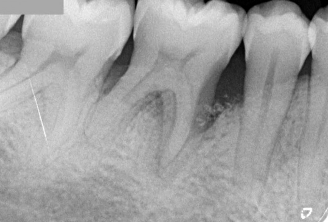 Regeneration at LR6 with cerabone® and collprotect® membrane using simple papilla preservation technique-7