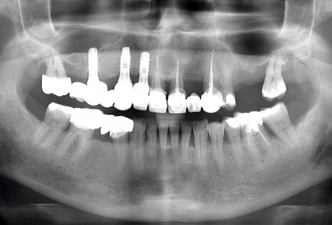 Immediate implant placement in the mandibular with collacone® max – Dr. D. Jelušić