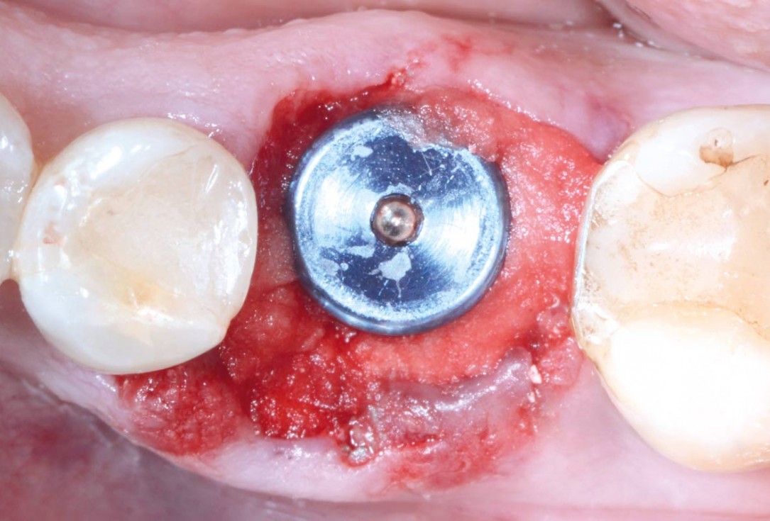 Immediate implant placement in the mandibular with collacone® max – Dr. D. Jelušić