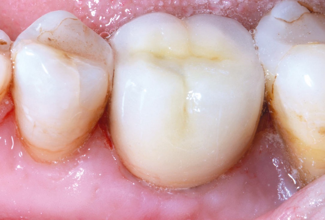 Immediate implant placement in the mandibular with collacone® max – Dr. D. Jelušić