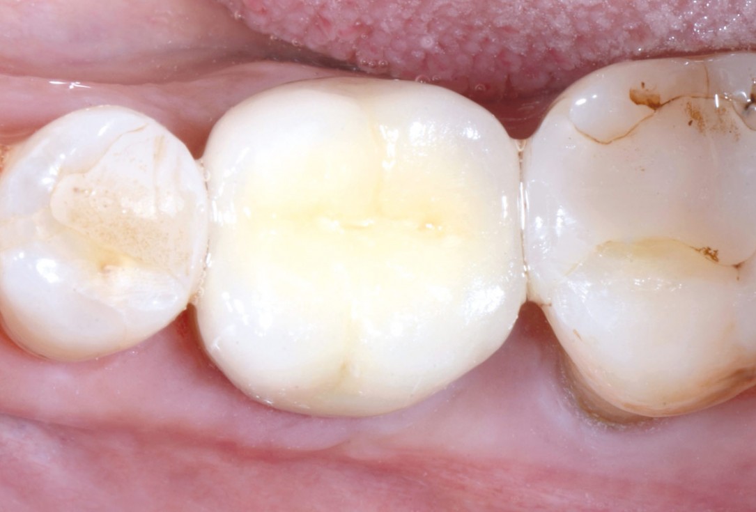 Immediate implant placement in the mandibular with collacone® max – Dr. D. Jelušić