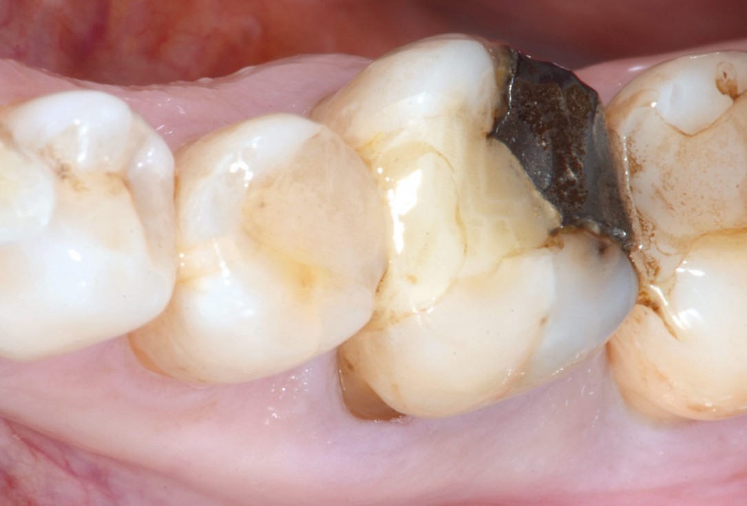 Immediate implant placement in the mandibular with collacone® max – Dr. D. Jelušić