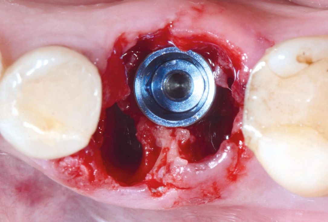 Immediate implant placement in the mandibular with collacone® max – Dr. D. Jelušić
