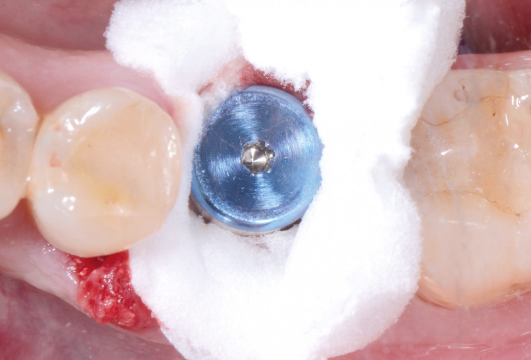 Immediate implant placement in the mandibular with collacone® max – Dr. D. Jelušić