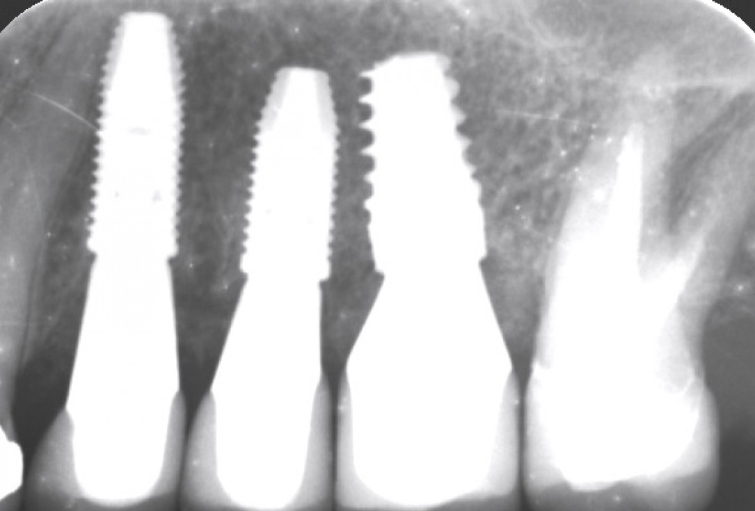 Multiple socket preservation in the maxilla with collacone® max – Dr. D. Jelušić