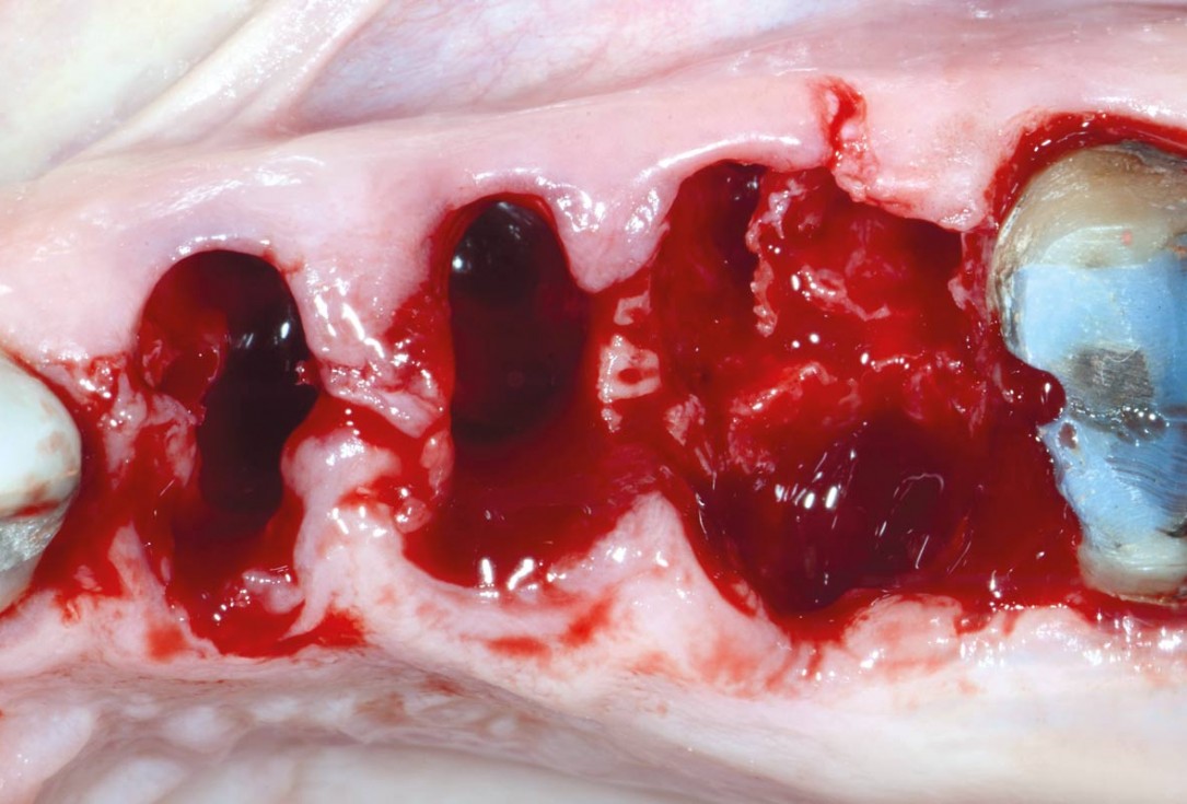 Multiple socket preservation in the maxilla with collacone® max – Dr. D. Jelušić