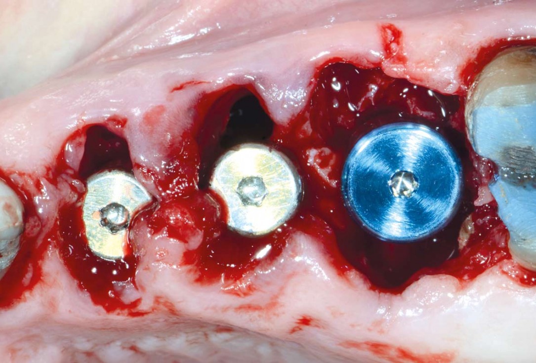 Multiple socket preservation in the maxilla with collacone® max – Dr. D. Jelušić