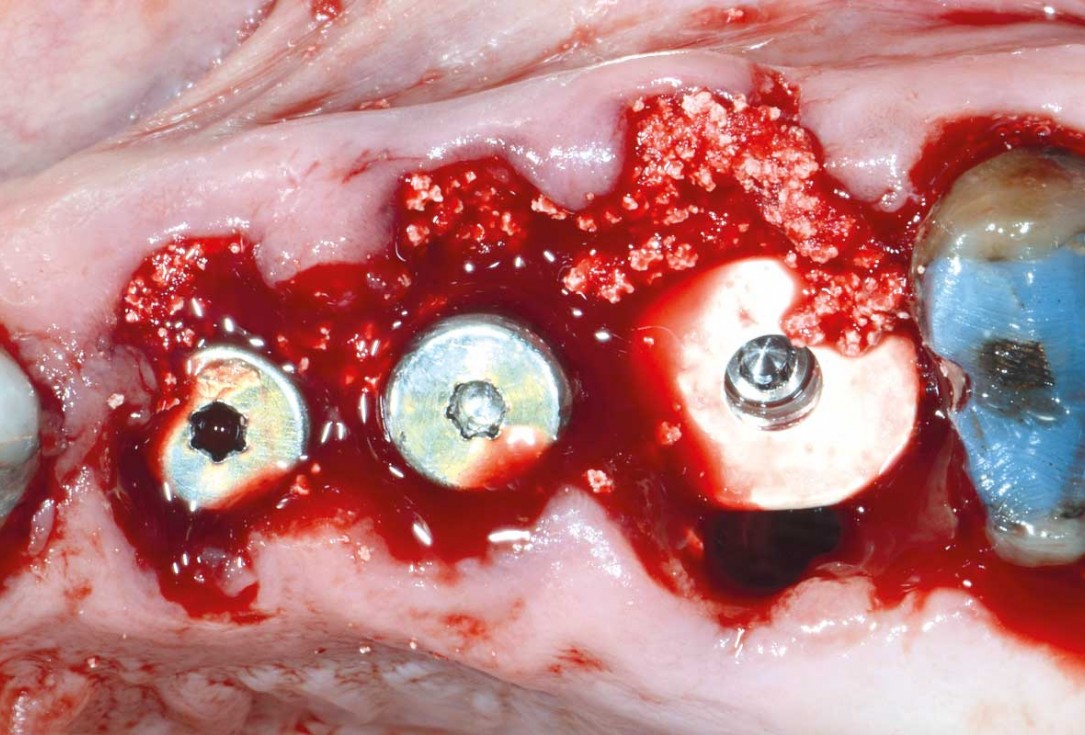 Multiple socket preservation in the maxilla with collacone® max – Dr. D. Jelušić