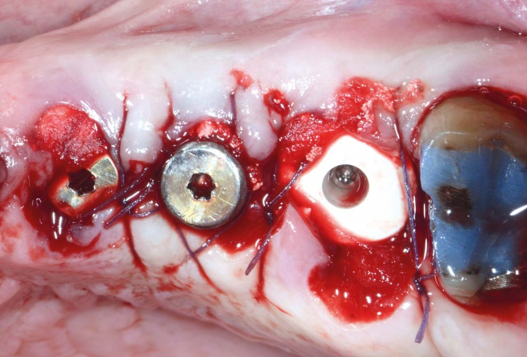 Multiple socket preservation in the maxilla with collacone® max – Dr. D. Jelušić