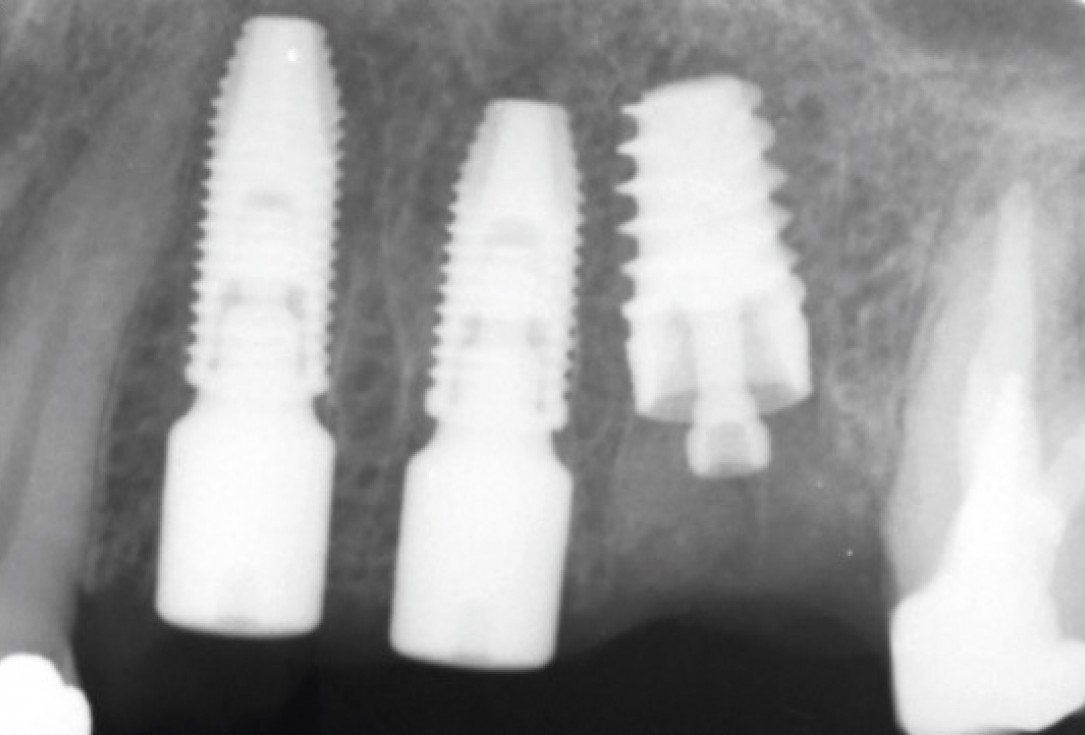 Multiple socket preservation in the maxilla with collacone® max – Dr. D. Jelušić